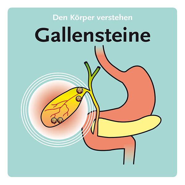 Gallensteine