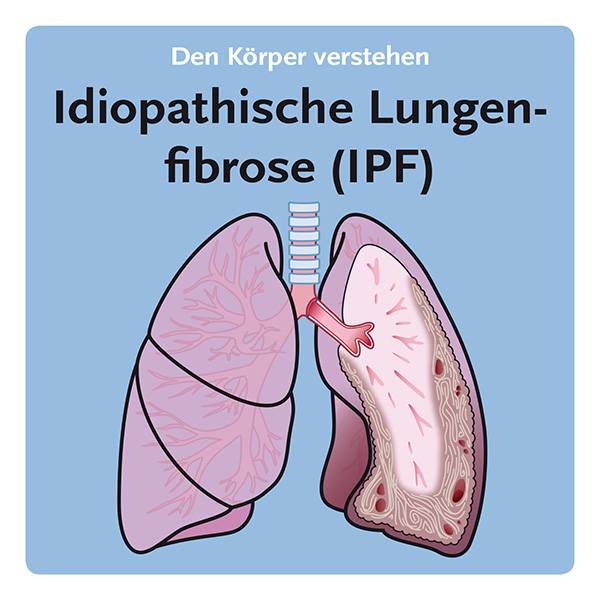 Idiopathische Lungenfibrose (IPF)
